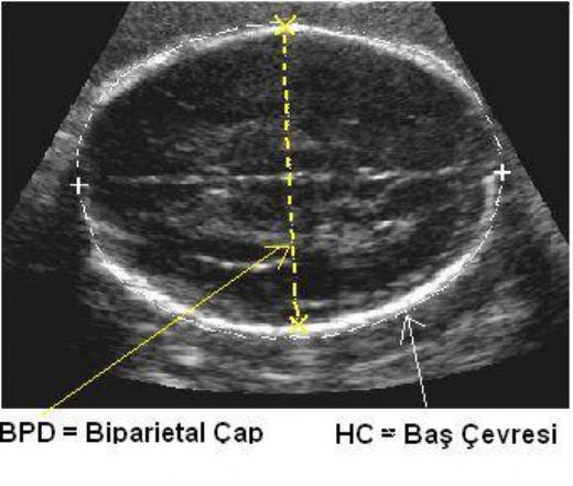 Gebelikte Ultrason Terimleri